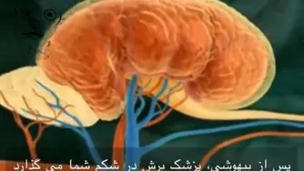 پیوند کلیه