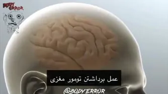 عمل برداشتن تومور مغزی