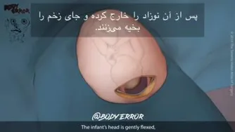 عمل سزارین