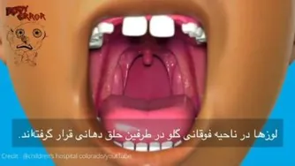 برداشتن لوزه