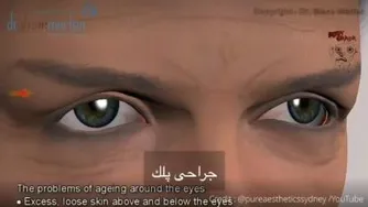 جراحی پلک
