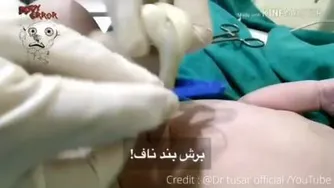 برش بند ناف