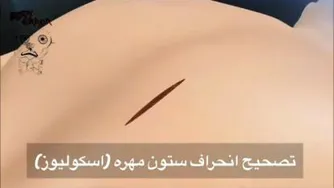 انحراف ستون مهره