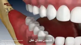 کشیدن دندان عقل