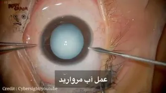 عمل آب مروارید
