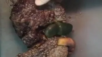 عواقب مصرف الکل