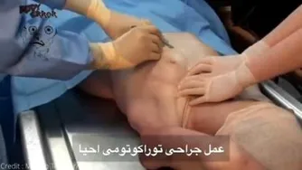 عنل جراحی توراکوتومی