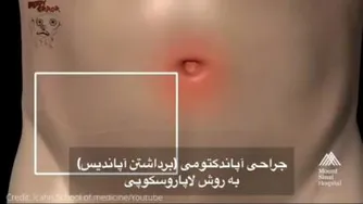 جراحی آپاندیس