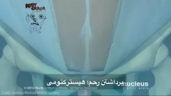 برداشتن رحم