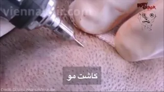 کاشت مو