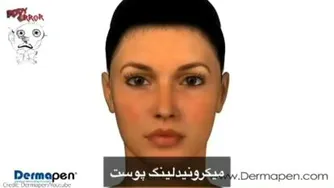 میکرومیدلینگ پوست