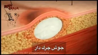 جوش چرکدار