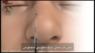 عمل جراحی آندوسکوپی سینوس