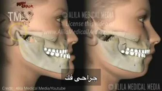 عمل جراحی فک