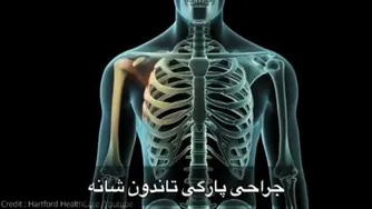 جراحی پارگی تاندون شانه