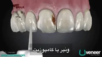ونیر یا کامپوزیت دندان