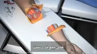 پیوند زدن دست