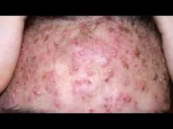اگر جوش های زیادی روی صورتت زده، حتماً اینو ببین! 🧏‍♀️