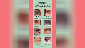 کدام چشم شماست؟ رایج‌ترین مشکلات دور چشم
