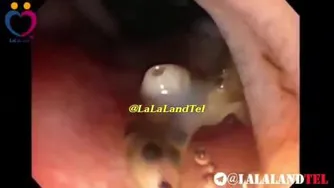 انگل فاسیولا هپاتیکا