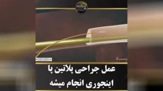 جراحی پلاتین پا🦴🔩⚒