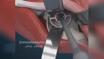 عمل جراحی تعویض لگن با ایمپلنت پروتز