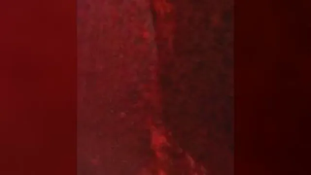 شکاف قطره خون نوک یک سوزن آمپول