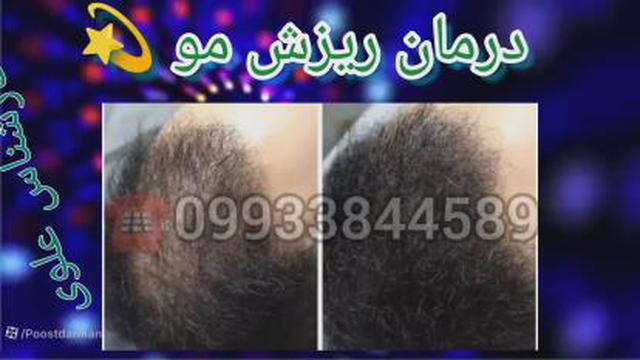 نمونه درمان ریزش مو