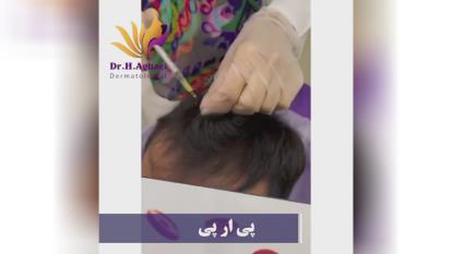 پی ار پی موی سر_رشد مجدد موی سر