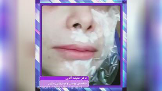 فیلم کربوکسی تراپی زیر چشم_رفع گودی و سیاهی زیر چشم