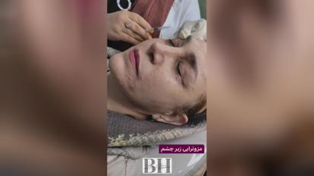 ژل و بوتاکس