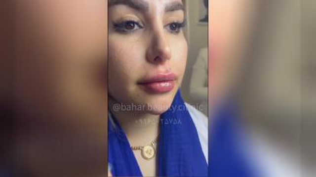 اموزش ژل و بوتاکس