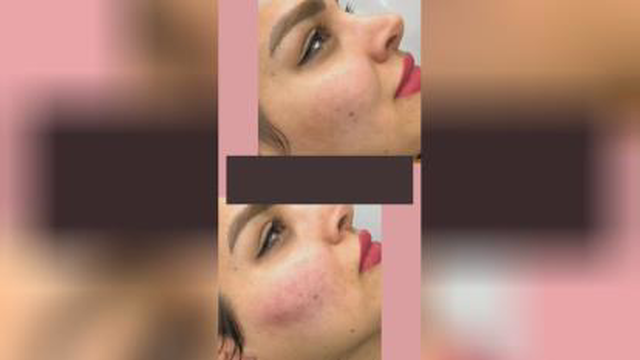 اموزش ژل و بوتاکس
