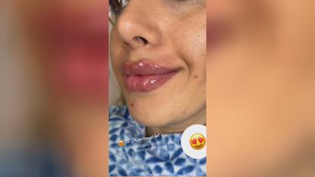 اموزش ژل و بوتاکس