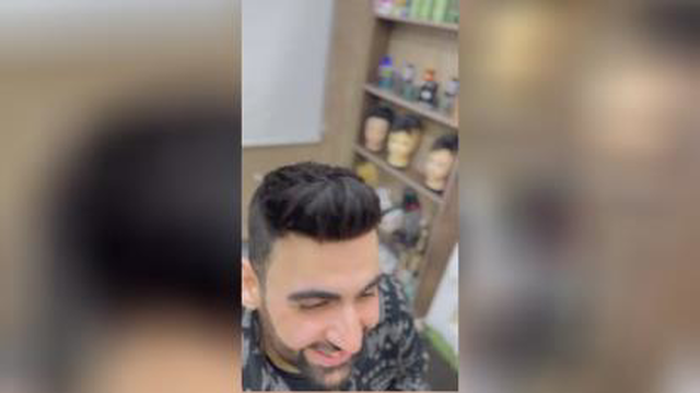 پروتز مو در تهران
