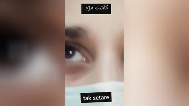 کاشت مژه تیتانیوم