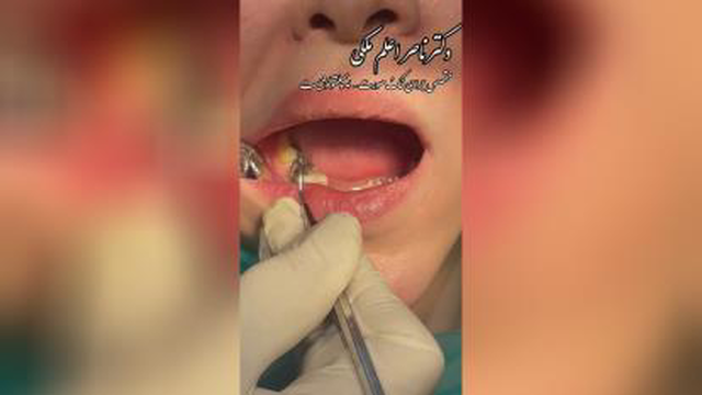 روکش فلزی pfm برای دندان ممنوع