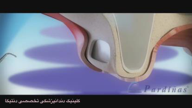 جراحی بالا بردن سینوس