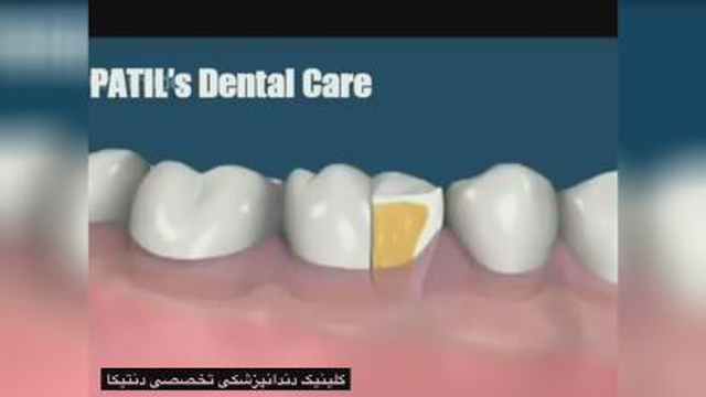 جراحی افزایش طول تاج