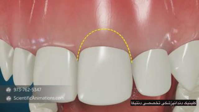 جراحی افزایش طول تاج در نواحی زیبایی