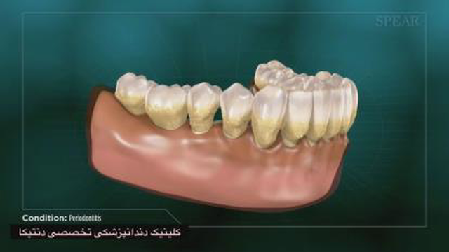 بیماری های لثه