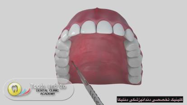 پیوند لثه