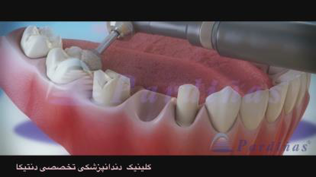 پروتز بریج