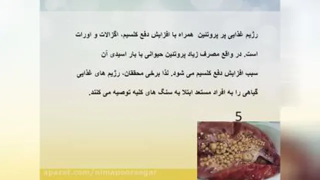سنگ کلیه