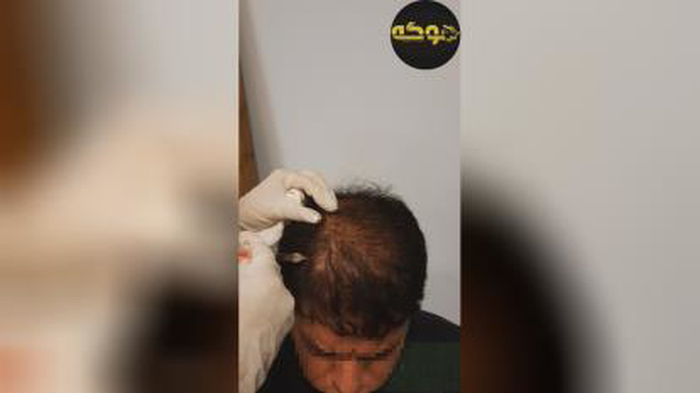 مزوتراپی مو در کرج، درمانی موثر جهت جلوگیری از ریزش و کم پشتی مو