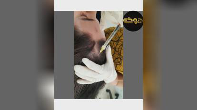مزوتراپی در کرج