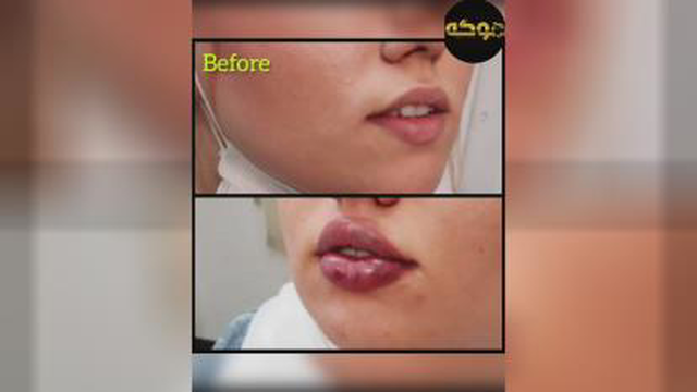 تزریق ژل در کرج