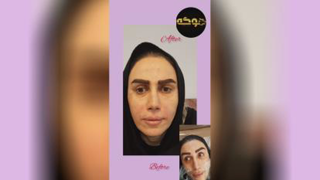 بوتاکس در کرج