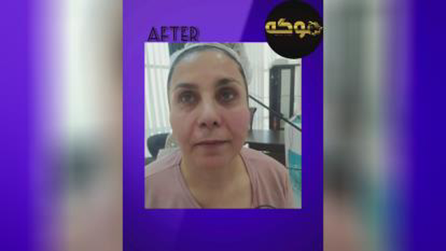 اندولیفت صورت در کرج