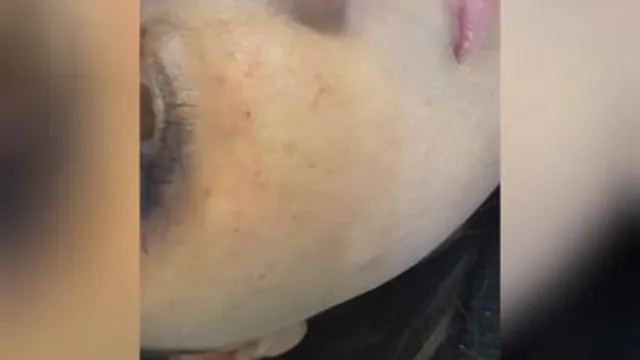 کربوکسی رفع تیرگی چشم